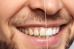 before-and-after teeth whitening treatment picture