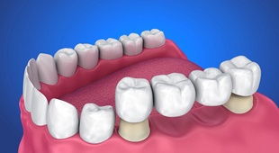 Illustration of dental bridge