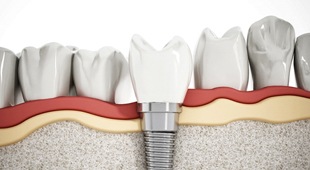 Illustration of dental implant