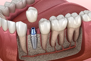 A digital image of a single tooth dental implant sitting on the lower arch between natural teeth