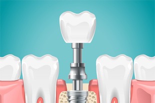 3D rendering of dental implant