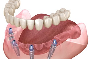 3D rendering of implant dentures 