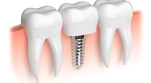 Illustration of dental implant; dental implant salvage in Deer Park, TX