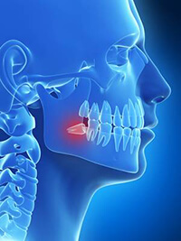 Animation of impacted wisdom tooth