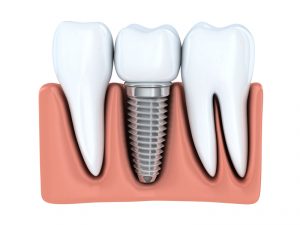Dental implants from Deer Park Dentistry replace one or more teeth lost to decay, gum disease or accident. Learn the details about these prosthetic wonders.