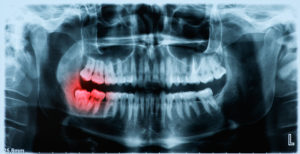 X-ray highlighting wisdom teeth