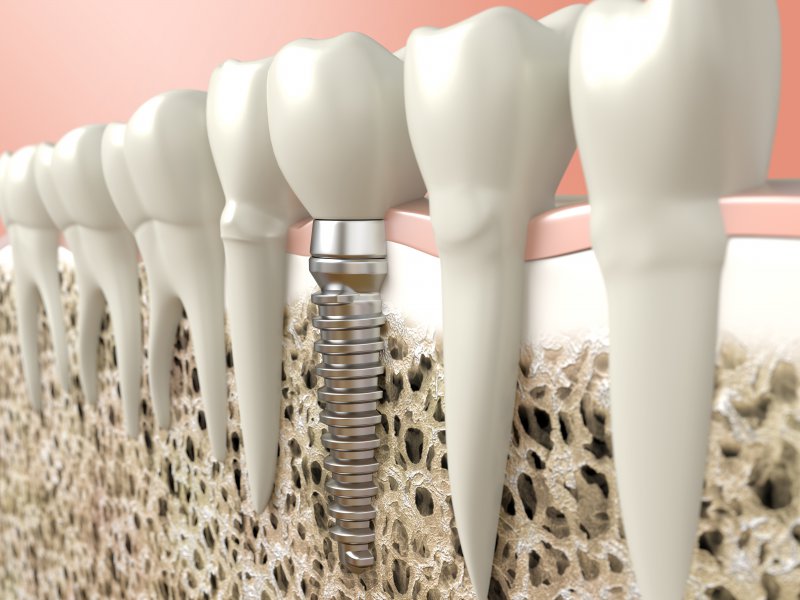  dental implants placed in the patient's mouth