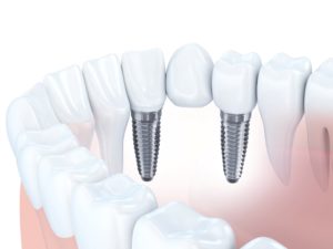 model of dental bridge