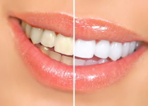 teeth smile whitening