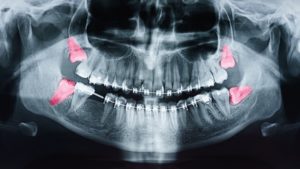 Dental X-ray highlighting four wisdom teeth coming in crooked