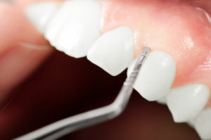 Close up of gum examination