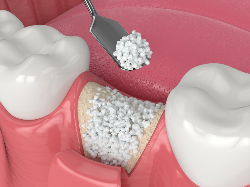 3D render of a bone graft